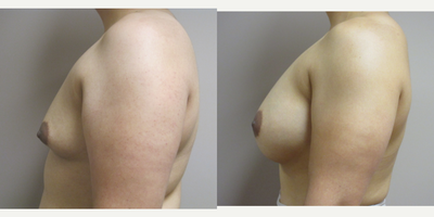 Mentor Breast Implants - Patient is 5'3 and 168 pounds.  Mentor smooth round moderate profile saline implants filled to 575 cc using the armpit incision.