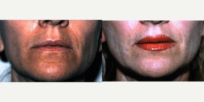 25-34 year old woman treated with Lip Surgery - In some cases, where a woman wants a more permanent solution to producing a fuller upper lip, instead of going above her lip margin with lipstick, surgery can be performed. This involves excising a slight amount of skin (white lip) above the lip margin and advancing the mucosa upwards. This is the only method that can be used to produces a more prominent Cupid's bow and change the actual outline of the lip. The lower lip was also augmented in this case.