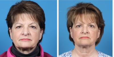 55-64 year old woman treated with Eyelid Surgery - Patient had a blepharoplasty (removal of excess upper eyelid skin) of both eyes.