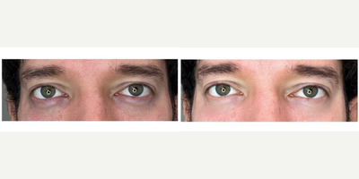 35-44 year old woman treated with Dermal Fillers - Notice that almost always in those dark circles or those folds denote a change in the characteristics of the color of the area. So it is necessary to apply it to improve the depth of the furrow and to show a decrease in the characteristics of the pigmentation. I am not saying that the application of hyaluronic acid corrects the pigmentation of the lower periorbital area. The original effect for those who do not know is like a translucency, hyaluronic acid is applied very superficially and it begins to look with bright color characteristics, different from the characteristics of normal skin.