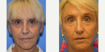 55-64 year old woman treated with Revision Rhinoplasty - revision rhinoplasty with rib graft