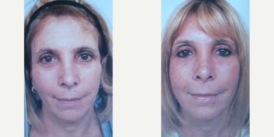 Fraxel re:pair - Patient four months following one Fraxel re:pair treatment of face, eye lids, and neck. Desiring to look her best for daughter's upcoming wedding.
