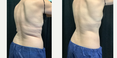 Woman treated with Cryolipolysis - Pre-Treatment vs Post-Treatment CoolSCulpting Elite. This patient had 2 rounds of CoolSculpting, 4 weeks apart.