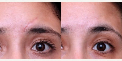 25-34 year old woman treated with Scar Removal - Surgical scar removal followed by scar resurfacing (dermabrasion & deepFX).