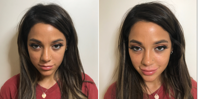 18-24 year old woman treated with Juvederm - Subtle before and after lip plumping with Juvederm.