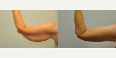 66 year old woman treated with Arm Lift - 66 year old woman 1 year following treatment with brachioplasty