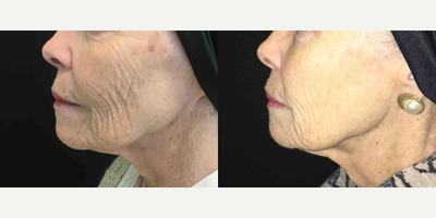 65-74 year old woman treated with Vivace - This patient was treated with full face Vivace Microneedling