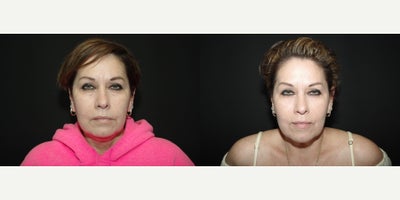 45-54 year old woman treated with Bellafill - 53 year old female received 1 syringe of Bellafill to the glabella and tear troughs; photos depict the patients results 3 months post-op.