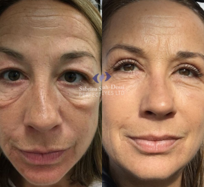 45-54 year old woman treated with Eye Bags Treatment - Eyebag surgery with a natural-looking result.