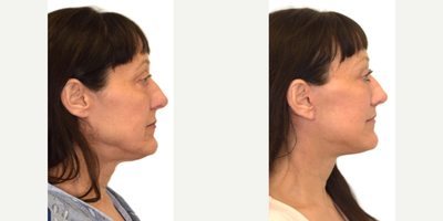 55-64 year old woman treated with Deep Plane Facelift, Brow Lift, Facial Fat Transfer, Eyelid Surgery, Lip Lift, Ellacor - 1. Extended deep-plane facelift2. Temporal brow lift3. Fat grafting to tear troughs and nasolabial folds4. Upper blepharoplasty5. Lip lift6. Ellacor to the forehead and perioral region