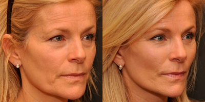 Woman treated with Fat Transfer - Fat Transfer