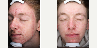18-24 year old man treated with LED Light Therapy - 18-24 year old man treated with LED Light Therapy to address live acne