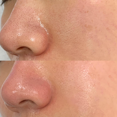 25-34 year old woman treated with HydraFacial - 25-34 year old woman treated with HydraFacial to detoxify skin