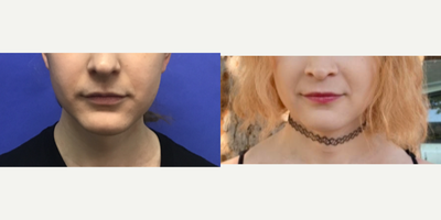Patient treated with Genioplasty - Chin Reduction and Contour - 25 to 34 year-old female patient is 9 months post-op from Facial Feminization surgery. Her procedures included: Forehead Lift, Hairline Lowering, Orbital Bony Contouring, Septorhinoplasty (closed) with Cartilage Grafts and Radix Graft, Cheek Implants (small), Chin Reduction and Contour, Soft Tissue to Nasolabial Folds,Intranasal Lip Lift with Fascia to Lips, Thyroid Cartilage Shave and Voice Feminization, Periorbital TCA Peel, and 300 Micrografts to Recessions.