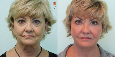 65-74 year old woman treated with Facelift - This active woman presented to our Center with the desire for full facial rejuvenation. She was unhappy with her tired appearing eyes, midface, jawline, and neck. Together in consultation we decided rejuvenate the upper eyes with an upper blepharoplasty to remove the excess skin over her eyelids. For her lower eyes and upper cheeks we decided to transplant abdominal fat, along with fractional CO2 laser to her lower eyelid skin. We additionally agreed upon a lower facelift and necklift to sharpen her jawline and treat her sagging turkey neck.All procedures were performed on the same day under local sedation and mild oral sedation (no general or IV sedation) in our Center. Her recovery time was under 2 weeks.
