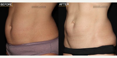 Woman treated with truSculpt - Woman treated with truSculpt
