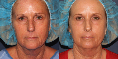 56 year old woman treated with Laser Peel - This 56 year old patient was treated one time by Dr. Groff with a combination of the Lumenis Ultrapulse Encore C02 laser and the Sciton Erbium laser. Notice the tightening and smoothing effect of wrinkles around the mouth and eyes. Also all of the age spots are gone, resulting in much more youthful appearing skin.