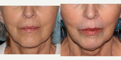 55-64 year old woman treated with Fraxel Repair - Fraxel Ultra Repair is used to smooth fine lines on the lower face.