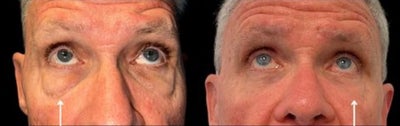 Man treated with Eyelid Surgery - Man treated with Eyelid Surgery
