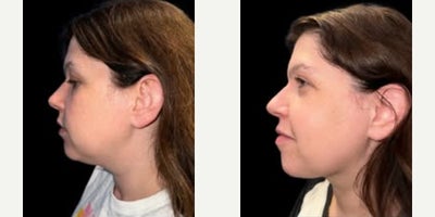 Woman treated with Chin Liposuction - Woman treated with Chin Liposuction