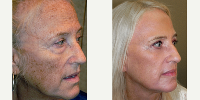 64  year old woman treated with RESET Laser Skin Resurfacing and lower lid blepharoplasty - This beautiful patient is allowing us to share her photos. She had abused her skin in the past in the sun and thought she was stuck with that damage. She underwent RESET Laser Skin resurfacing with lower lid blepharoplasty. She had a beautiful result and now her skin not only is more attractive but in addition it is fundamentally healthier as well after all the sun damage was removed.