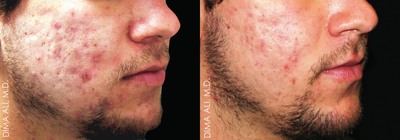 25-34 year old man treated with Smoothbeam Laser - This patient received 5 treatments of the Smoothbeam Laser to treat his acne and acne scarring.