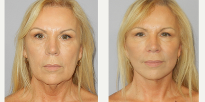 55-64 year old woman treated with Facelift, MACS Facelift, Facial Fat Transfer - 61 year old lady ungergoing modified extended MACS facelift and fat grafting.