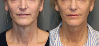 Mini Lift and Lower Lids - Minimally invasive lower facelift.