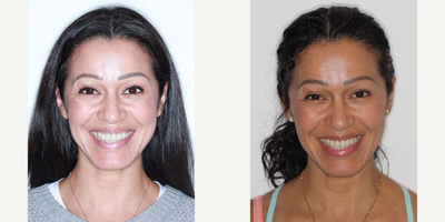 Woman treated with Braces - Woman treated with Braces.