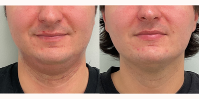 18-24 year old woman treated with Kybella - 3 treatments of Kybella