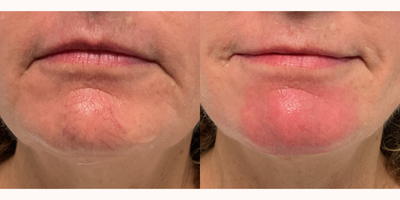 45-54 year old woman treated with BroadBand Light (BBL) - Immediately after treated facial spider veins with BBL