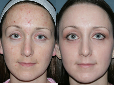 Fraxel Repair for Acne Treatment - 
	24 year old female with melasma which developed after pregnancy, acne, and acne scars. Notice significant improvement in all aspects of her skin. She has no makeup on her skin!

