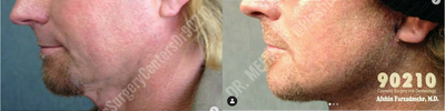 Man treated with Facelift - Man treated with Facelift