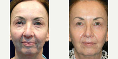 Woman treated with Microneedling - Woman treated with Microneedling