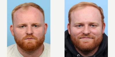 25-34 year old man treated with FUE Hair Transplant, Hair Transplant, Hair Loss Treatment, PRP for Hair Loss - Dr. Wise performed an FUE hair transplant on this patient, along with one treatment of PRP therapy, to restore thinning hair in the front and his rebuild his once receding hairline.