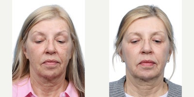 62 year old woman treated with Eyelid Surgery, CO2 Laser - At 62, this female patient was concerned with aging skin and excess fat pads around her eyes. She underwent upper and lower blepharoplasty, achieving a refreshed, more youthful, and well-rested appearance.
