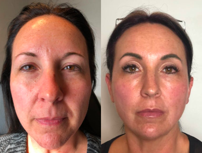 45-54 year old woman treated with Thread Lift - This is a before and immediately after pic of a PDO thread lift. I used 2 molded threads per side.