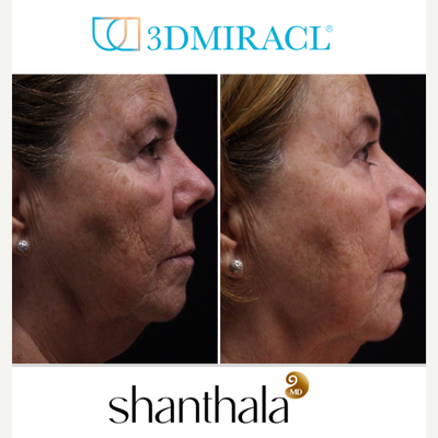 3DMIRACL Laser procedure by Dr. Shanthala - 3DMIRACL laser is an excellent choice for long-term skin health, superficial skin resurfacing with no numbing.