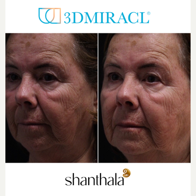 3DMIRACL Laser procedure by Dr. Shanthala - 3DMIRACL laser is an excellent choice for long-term skin health, superficial skin resurfacing with no numbing.