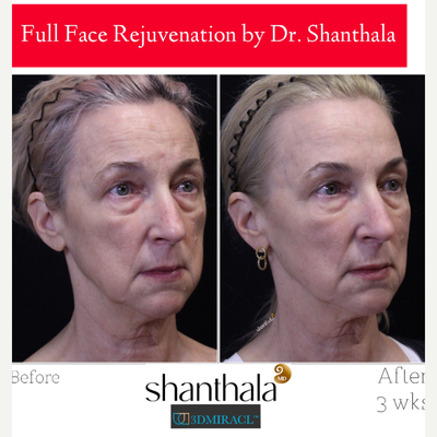 3DMIRACL Laser procedure by Dr. Shanthala - 3DMIRACL laser is an excellent choice for long-term skin health, superficial skin resurfacing with no numbing.
