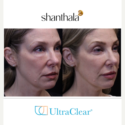 UltraClear Laser, Skin Rejuvenation, Laser Resurfacing, Fractional Laser by Dr. Shanthala - Laser-Coring with UltraClear laser after removal of under eye fillers resulted in peri-orbital rejuvenation, and fuller cheeks & more refreshed, youthful results performed by MD only.