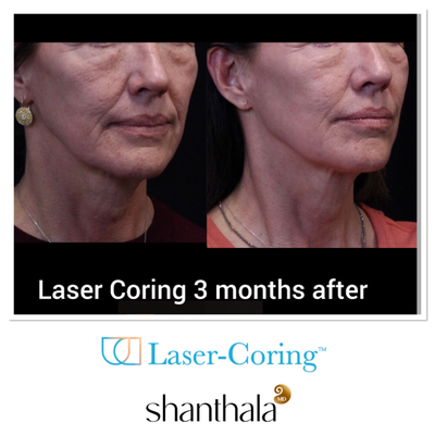 UltraClear Laser & Laser-Coring by Dr. Shanthala - Laser-Coring with UltraClear Laser was performed after Cheek volume correction, under eye fillers & lip fillers on the same day by Dr. Shanthala