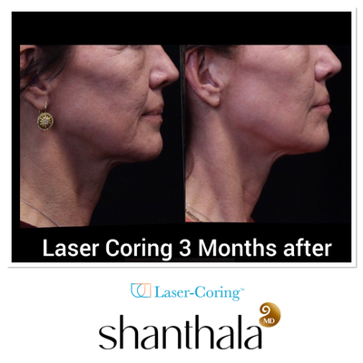 UltraClear Laser & Laser-Coring by Dr. Shanthala - Laser-Coring with UltraClear Laser was performed after Cheek volume correction, under eye fillers & lip fillers on the same day by Dr. Shanthala