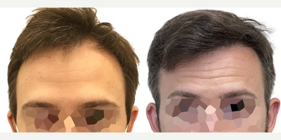 31 year old man treated with Rogaine - This is a 31-year-old male patient with a 10-year history of hair loss manifested as slowly enlarging recessions in the hairline. The left side was thinning at a faster rate than the right.Wed previously talked in consultation about 4 months prior to his surgery and at that time he wasnt taking any steps to preserve his existing hair. Following our conversation, he started using the Biolightlow-level laser therapy cap and had been using this for about 4 months prior to his surgery.We performed a 1316 graft FUE surgery with the main goal of restoring the hairline and filling in the recessions. We also added a little density behind his existing hairline to give the cosmetic effect of a fuller hairline overall. You can see from the operative drawing that we used an irregularly irregular pattern in the hairline to mimic a natural hairline while maintaining natural, masculine, sharp frontotemporal angles.Following his surgery, we started him on once-daily high-strength minoxidil to further optimize his existing hair and encourage the growth of his transplant follicles.He returned to us 15 months after his surgery with a result!He can now confidently wear his hair in any way he likes and he hasnt lost any more hair since starting his laser cap and minoxidil.