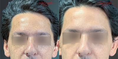 35-44 Years Old Man Treated with PicoSure - The final appearance of our patient, whose freckles on his face were removed; after the treatment process.