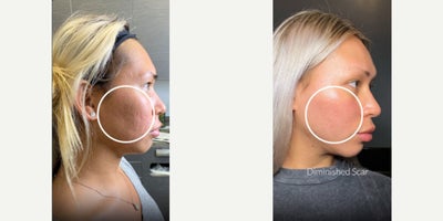 18-24 year old woman treated with Subcision, Bellafill, Halo Laser, CO2 Laser - This patient was so excited to see me! She was looking to reclaim her confidence and finally address the acne scars that had been impacting her self-esteem for years. With a custom combination treatment, we targeted her scars from every angle, but the real magic lies in the healing process!Heres the treatment plan that made it happen: Subcision Bellafill Halo CO2 Spot Treatment PRPGot scars?