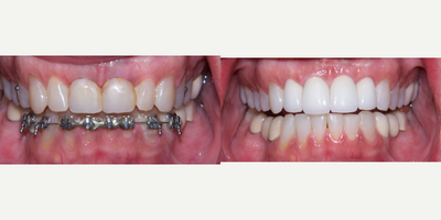 55-64 year old woman treated with Dental Crown - Implant Dental Crowns on 55-64 year-old female with Ortho