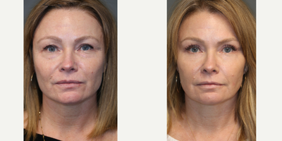 Upper and Lower Eyelid Surgery - Upper and lower eyelid surgery with laser.