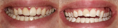 25-34 year old man treated with KoR Teeth Whitening - Patient presents to office to fix his chips on his anterior teeth, he also wanted them brighter so we started off with Kor in-office whitening. The after picture is from one session of in-office Kor whitening.