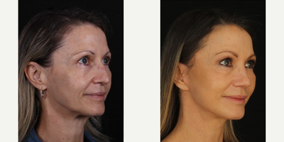 45-54 year old woman treated with Facelift, Facial Fat Transfer - Facelift, fat transfer B&A.